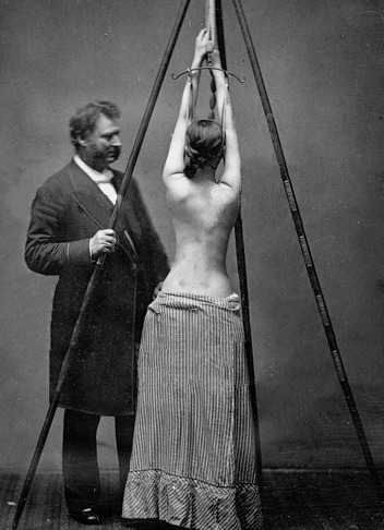 Ein Arzt behandelt eine junge Frau mit Skoliose. Schwarzweißfoto, ca. 1877.